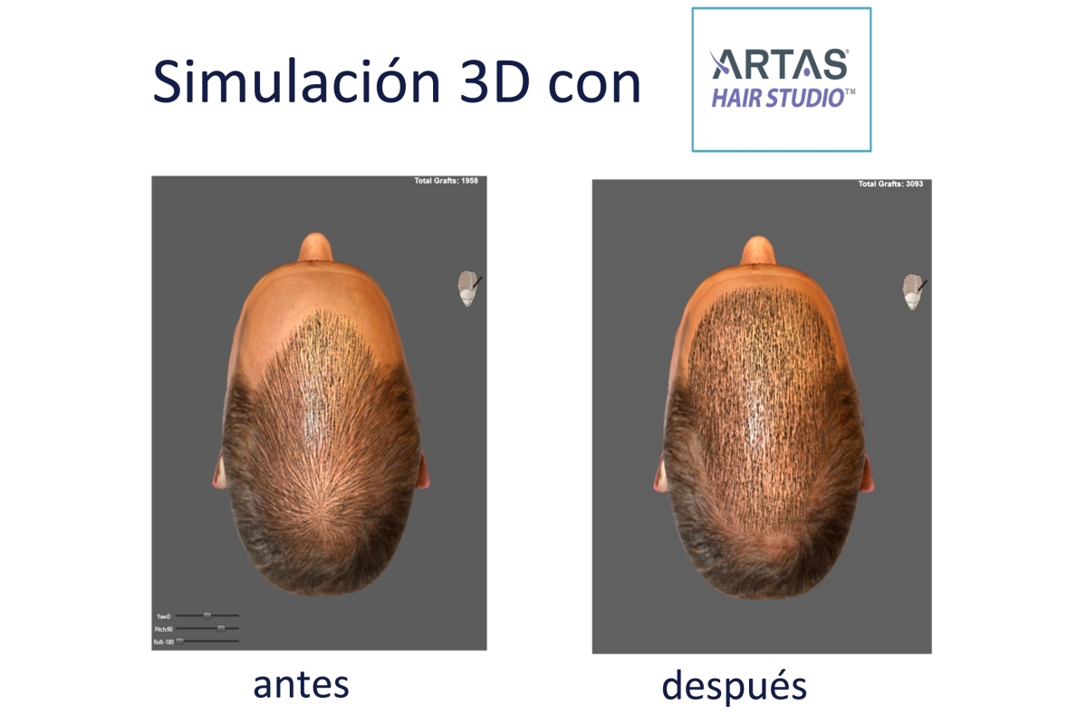 Robot Artas Lopez Bran trasplante de pelo